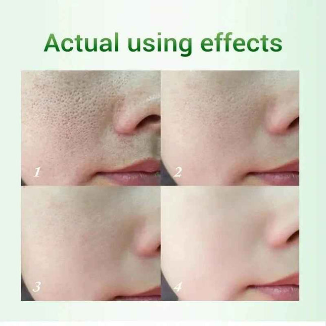 Crema Facial Ácido Salicílico para Poros y Grasa