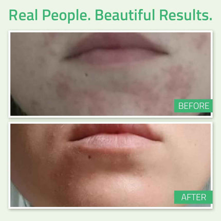 Peeling Facial Ácido Glicólico 30% con Retinol y Té Verde