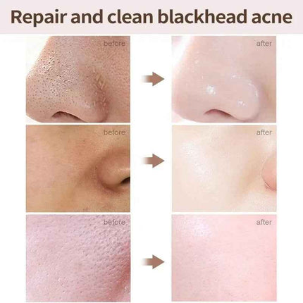 Crema Facial Ácido Salicílico para Poros y Grasa